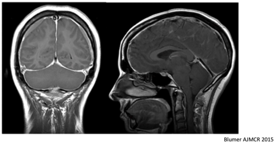 High And Low Pressure Headache Headache Australia